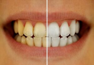 Blanqueamiento Dental antes y después ejemplo