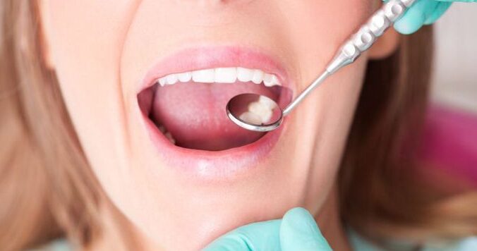 Síntomas y Signos Precoces de la Descalcificación Dental
