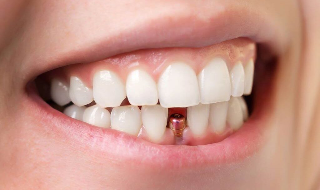 Implantes Dentales precio