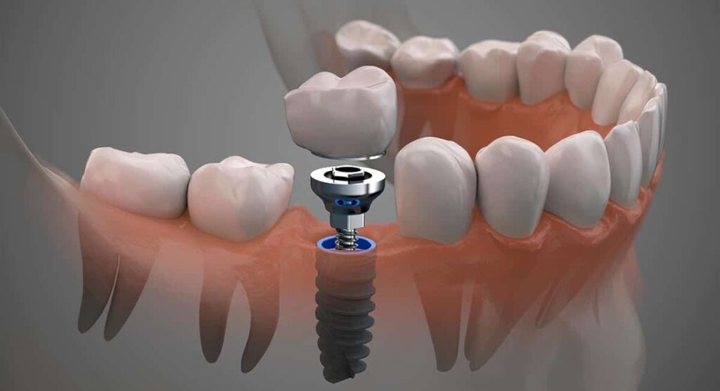 Qué es un implante dental