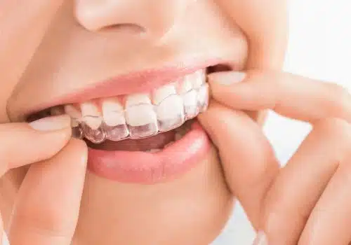 tratamientos dentales en barcelona-Dental Spa Clinics