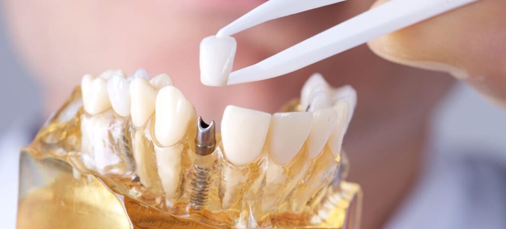 Implantología Dental-implante dental