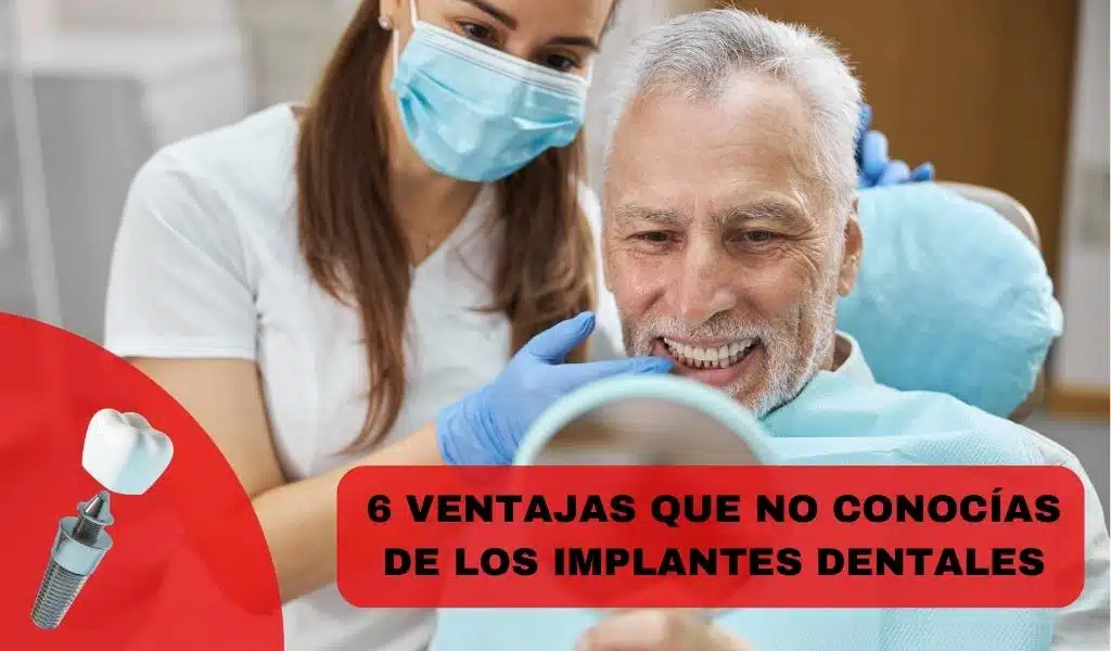 6 Ventajas Que No Conocías De Los Implantes Dentales